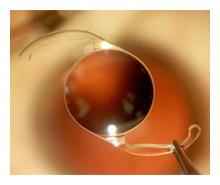 premium lens implants arizona