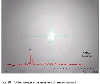 IOLMaster axial length measurement