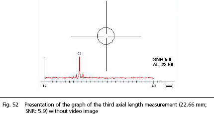 IOL Master Axial Length Measurements