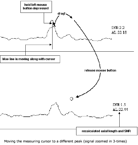 IOL Master Axial Length Measurements