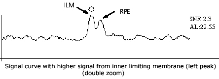 IOLMaster Axial Length Measurements