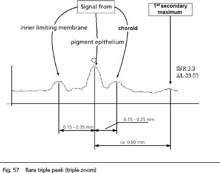 IOLMaster Axial Length Measurements