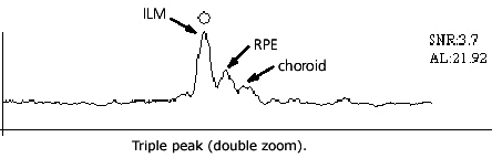 IOLMaster Axial Length Measurements