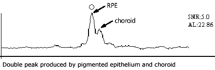 IOLMaster Axial Length Measurements