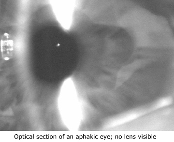 Cataract Surgery Arizona