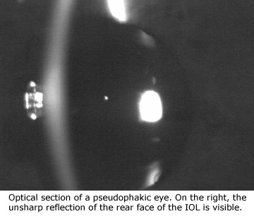 Cataract Surgery Arizona