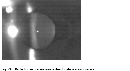 Cataract Surgery Arizona