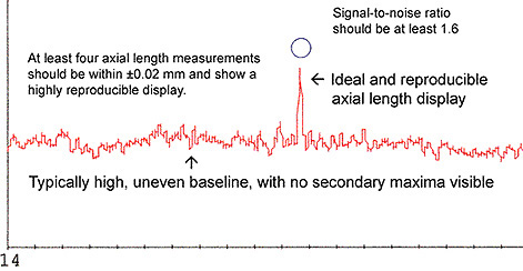 Moderate to Dense Cataract