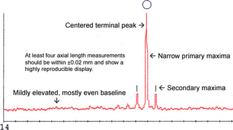 Mild to Moderate Cataract