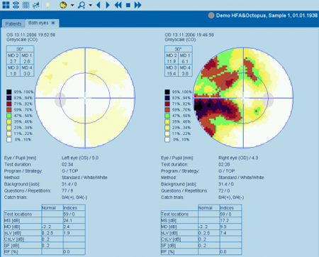 Haag Streit Perimetry OCTOPUS 900 Screen Both Eyes