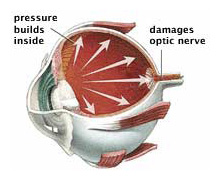 glaucoma specialist arizona