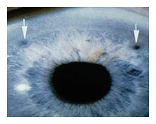 glaucoma treatments iridotomy