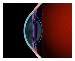 Presbyopia Restor Mesa Arizona