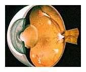 Diabetic retinopathy arizona