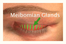 dry eye doctor arizona