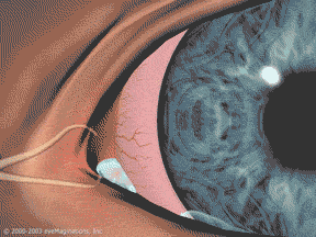 treatment of dry eye arizona