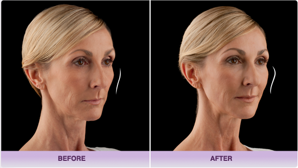 JUV&eacute;DERM VOLUMA™ XC before and after