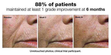 juvederm injections tempe arizona