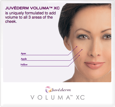 juvederm mesa arizona