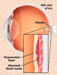 Macular Degeneration Arizona