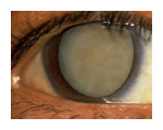 eye surgery arizona cataract