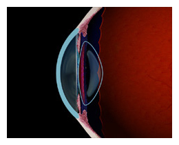 Presbyopia  Restor Tempe Arizona