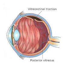 vitreous detachment arizona eye doctor