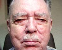 Patient 4 Before Plastic Surgery Mesa Arizona