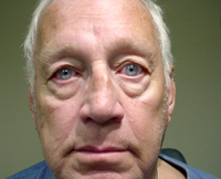 Patient 2 Before Plastic Surgery Mesa Arizona