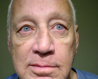Patient 2 After Eyelid Surgery Mesa Arizona
