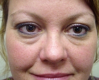 Patient 1 Before Best Plastic Surgery Mesa Arizona