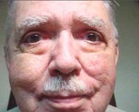 patient photo, plastic eyelid surgery in Mesa, AZ