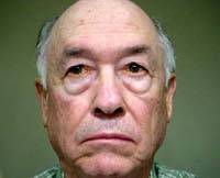 patient photo, plastic eyelid surgery in Mesa, AZ