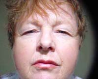 patient photo, plastic eyelid surgery in Mesa, AZ