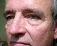 patient photo, plastic eyelid surgery in Mesa, AZ