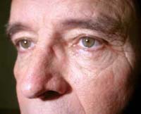 patient photo, plastic eyelid surgery in Mesa, AZ