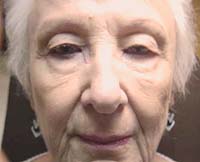 patient photo, plastic eyelid surgery in Mesa, AZ