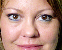 patient photo, plastic eyelid surgery in Mesa, AZ