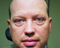 patient photo, plastic eyelid surgery in Mesa, AZ