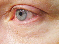 patient photo, plastic eyelid surgery in Mesa, AZ