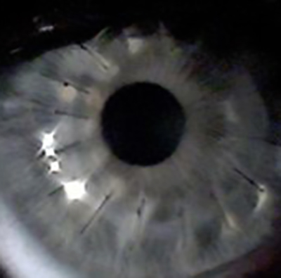 Corneal Transplantation