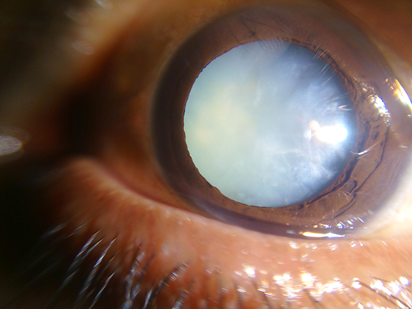 mature cataract