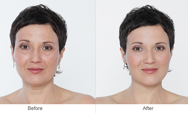 Eyelid Plastic Surgery