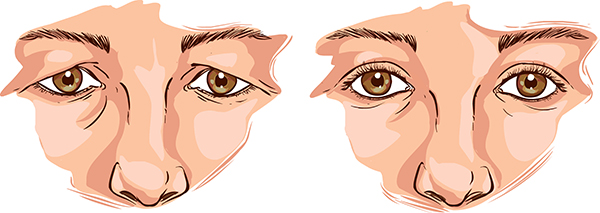 Blepharoplasty - Eyelid Plastic Surgery