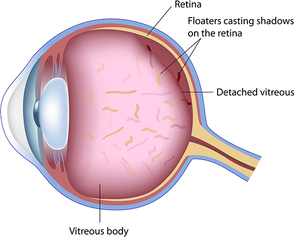 Floaters and Flashes
