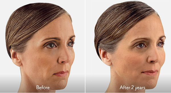Juvederm Dermal Filler