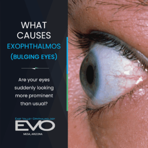 What causes Exophthalmos (Bulging Eyes)