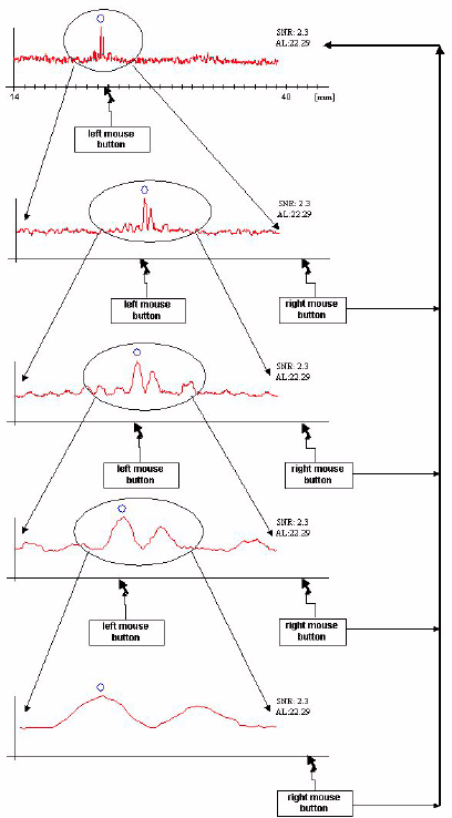 Zeiss IOL Master Axial Length Measurements