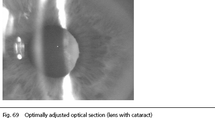 Anterior Chamber Depth on IOLMaster