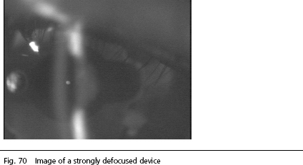 Cataract Surgery Arizona